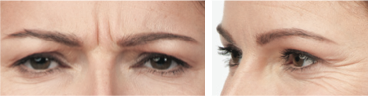 botox before and after photos