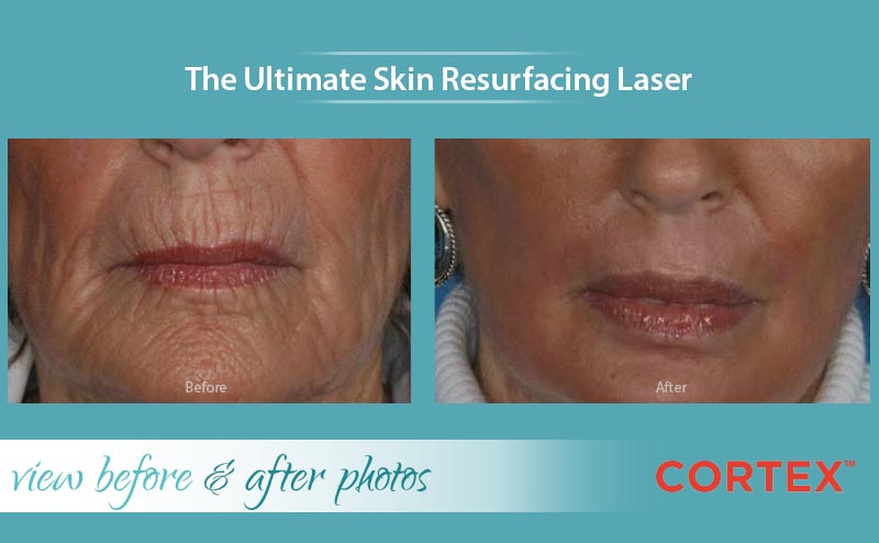 skin resurfacing laser