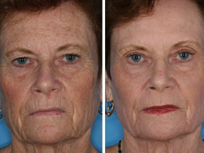Skin Resurfacing Laser Photos