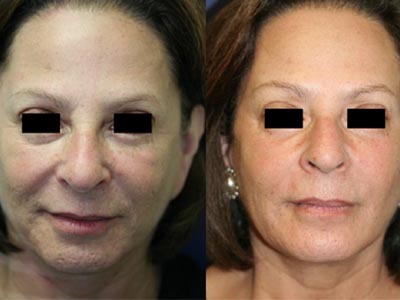 CO2 skin rejuvenation