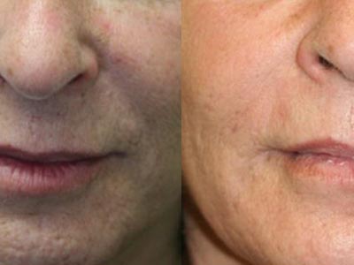 CO2 skin rejuvenation