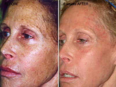 CO2 skin rejuvenation