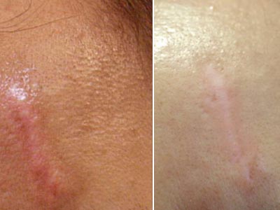CO2 skin rejuvenation