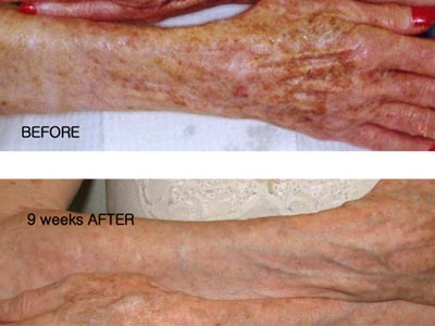 CO2 skin rejuvenation