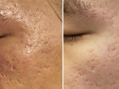 CO2 skin rejuvenation