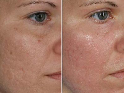 CO2 skin rejuvenation