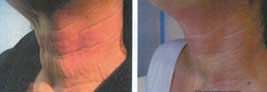Pelleve Radiofrequency Treatment